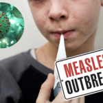 US Faces Measles Explosion in 2024 Due to Plummeting Vaccine Rates